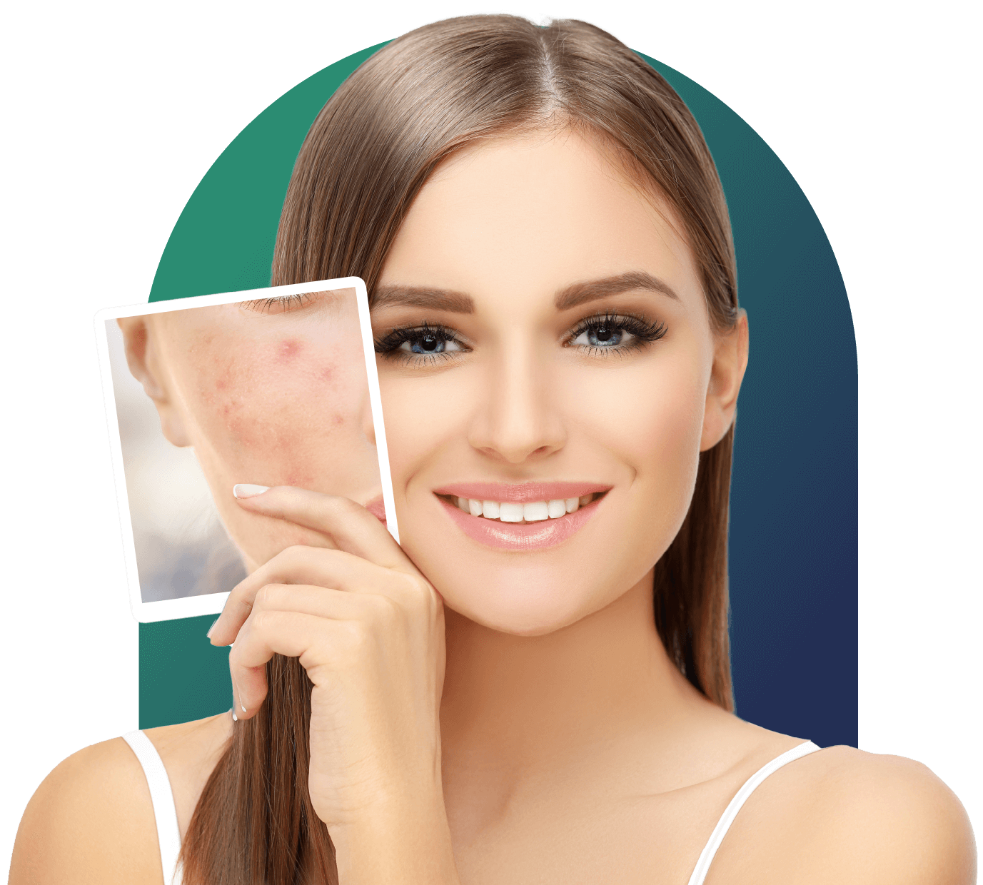 Acne treatment services